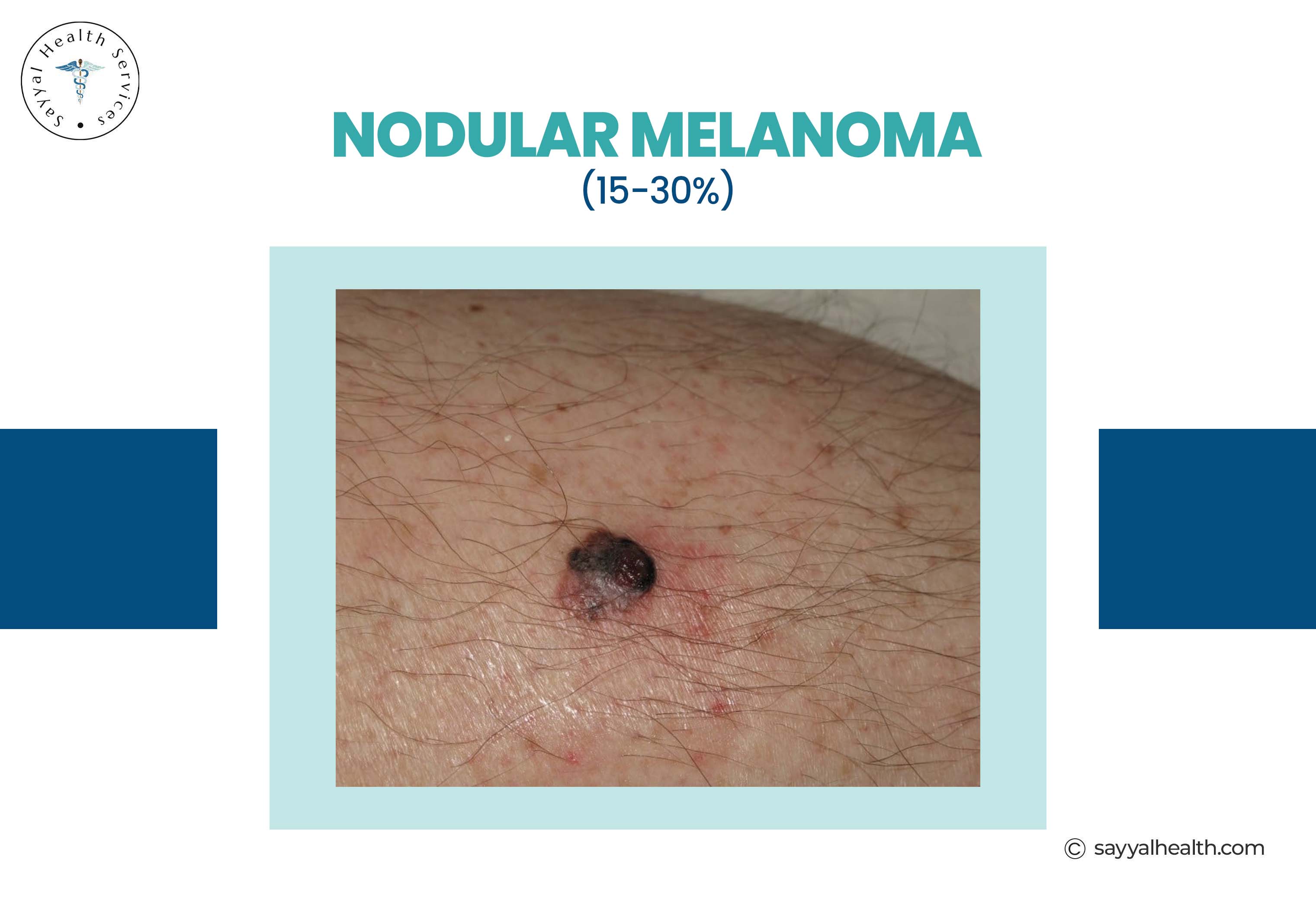 Nodular melanoma appearing as raised dark lesion on skin - 15-30% of cases